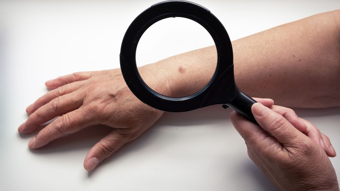 Ne vigyük túlzásba a napon tartózkodást! A melanoma kialakulására figyelmeztet az NNGYK